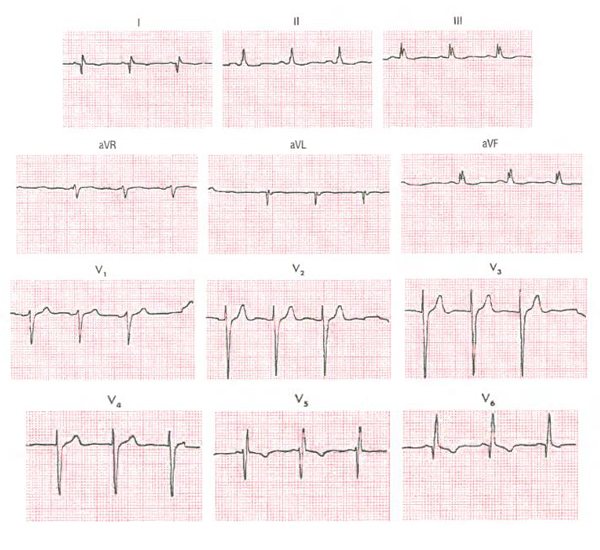 Nonspecific intraventricular conduction disorder with a wide QRS complex