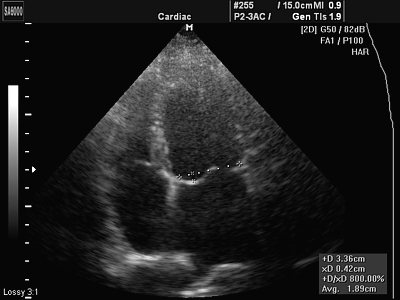 Minor prolapse of the anterior leaflet of the mitral valve (normal variant)