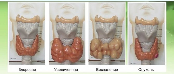 Volumetric images of the thyroid gland for various diseases in the form of enlargement of the organ or the presence of neoplasms