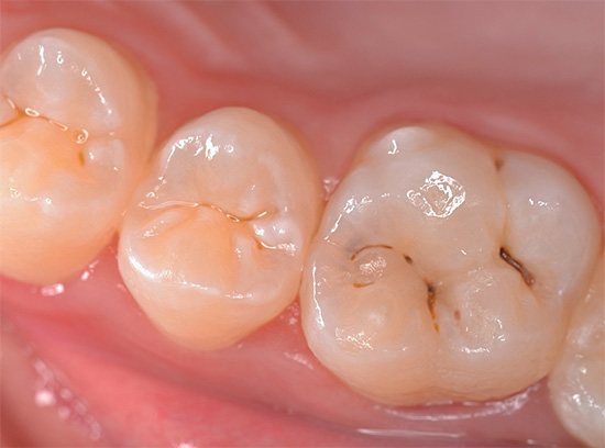 Очень часто кариесом поражаются фиссуры зуба - естественные углубления на его жевательной поверхности.