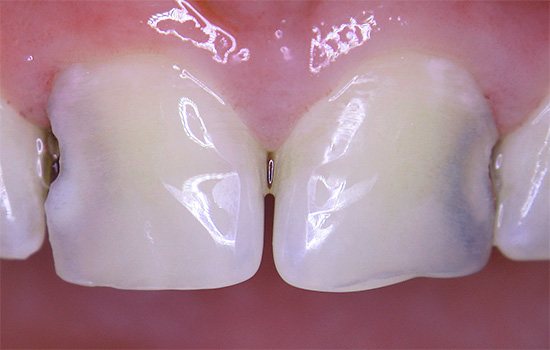 However, as the cavity between the teeth grows, the problem eventually becomes visible to the naked eye.