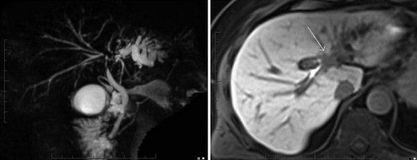 Klatskin tumor on MR cholangiography images