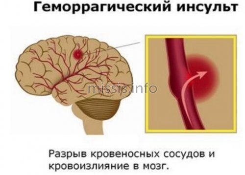 Complication of hemorrhagic stroke