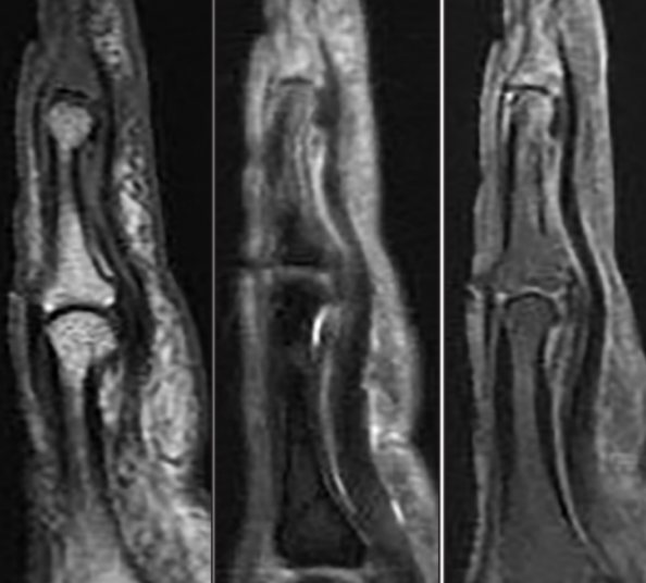 Osteomyelitis of the distal phalanx on MRI after a dog bite