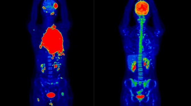 A 19-year-old patient diagnosed with Diffuse large B-cell lymphoma, the image on the left is the results of a PET/CT study to assess the extent of the malignant process (red areas) before treatment, on the right is the results after 2 courses of chemotherapy.