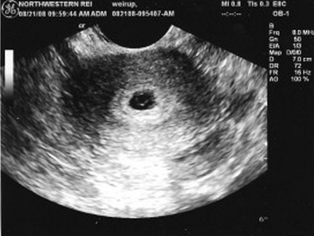 fertilized egg on ultrasound