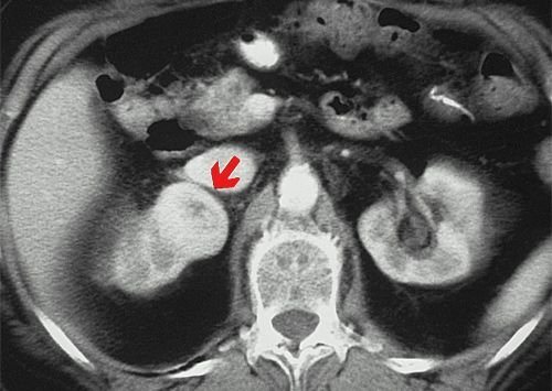 Causes and risk factors for ovarian cancer