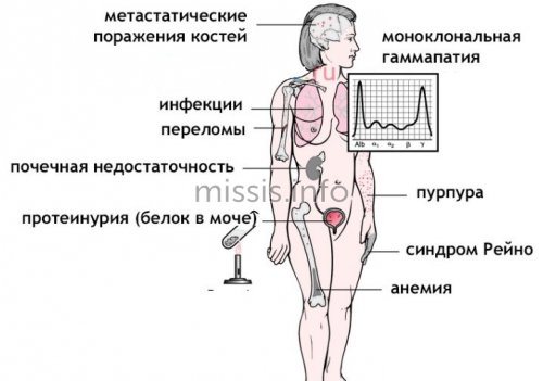 Causes of bone marrow pathology