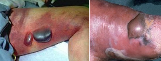 Signs of gas gangrene on the extremities