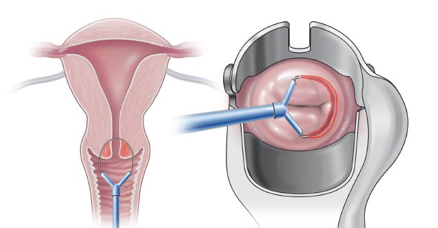 Fallopian tube cancer - surgical treatment