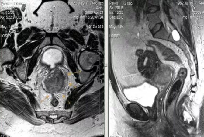 Cervical cancer in MRI image