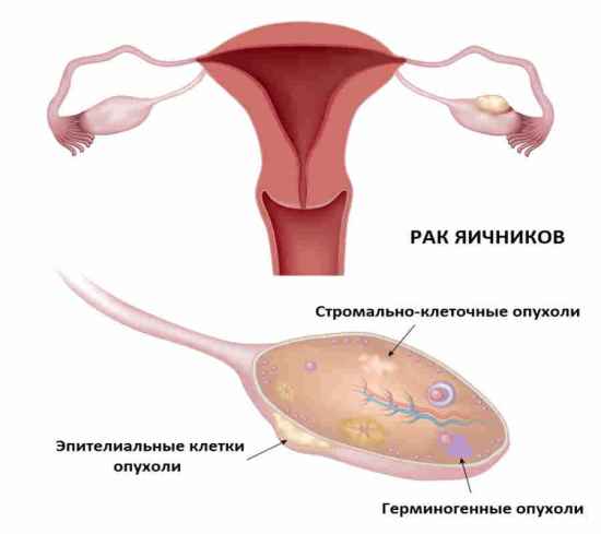 Рак яичников - схематическое изображение
