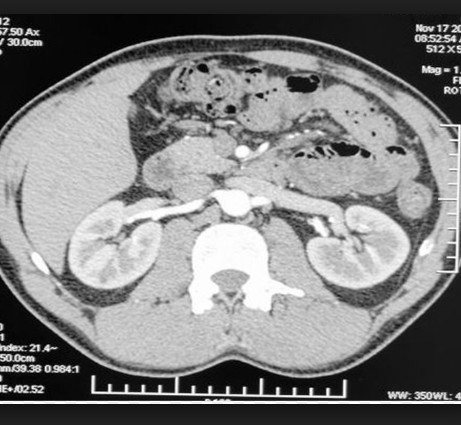 Interpretation of CT scan of the kidneys