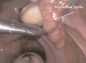 Dilated fallopian tube