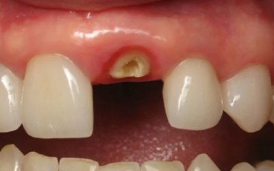 Разрушение корня зуба - Стоматология Линия Улыбки