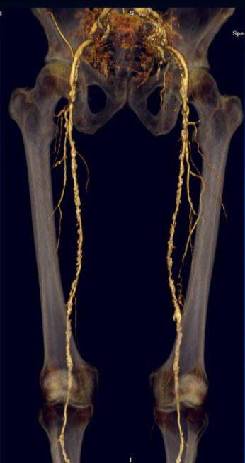 Reconstruction of CT angiography of leg vessels