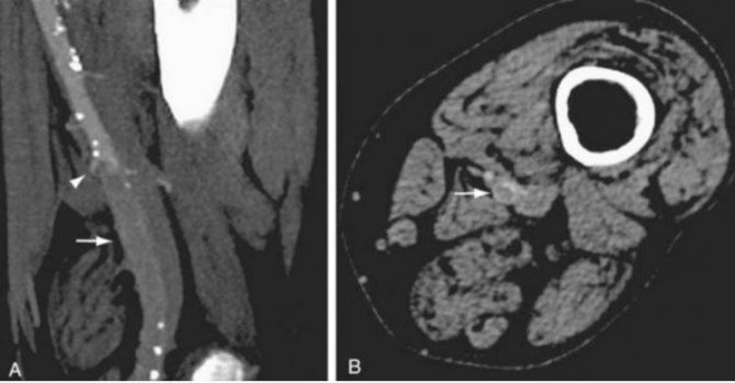 Sagittal (A) and axial (B) images of CT angiography show occlusion of the left superficial femoral artery (indicated by arrows)