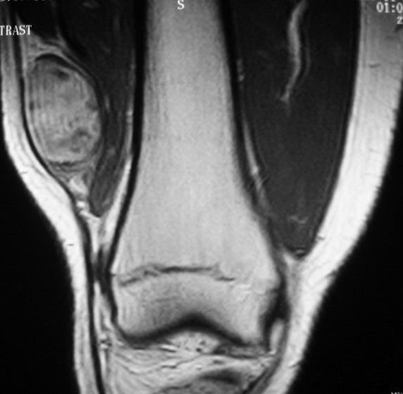 Soft tissue sarcoma of the thigh on MRI