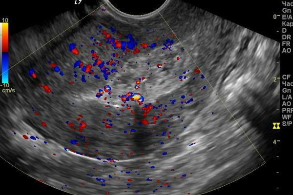 Blood clot in the uterus after childbirth on ultrasound