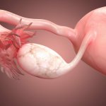 Синдром истощенных яичников: причины появления и диагностика
