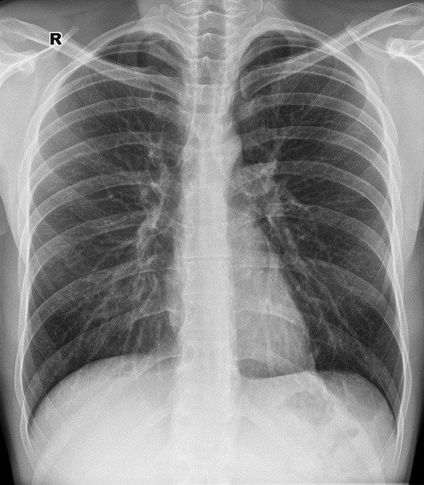 Снимки легких при туберкулезе: фото и подробные описания