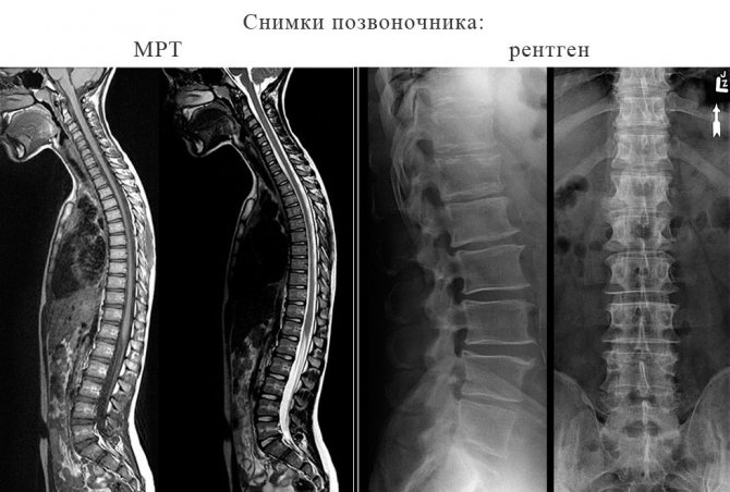 Spine pictures