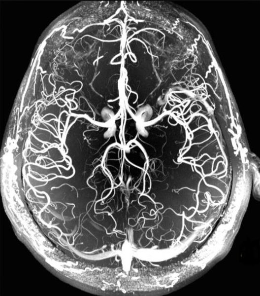 MRI image of cerebral arteries
