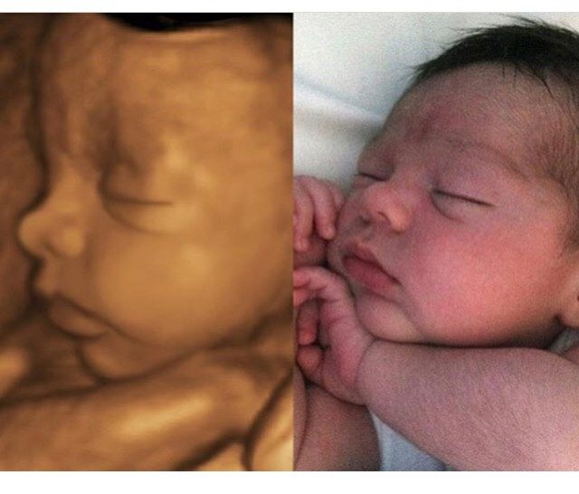 Снимок плода в режиме 3D (слева) и фото новорожденного (справа)