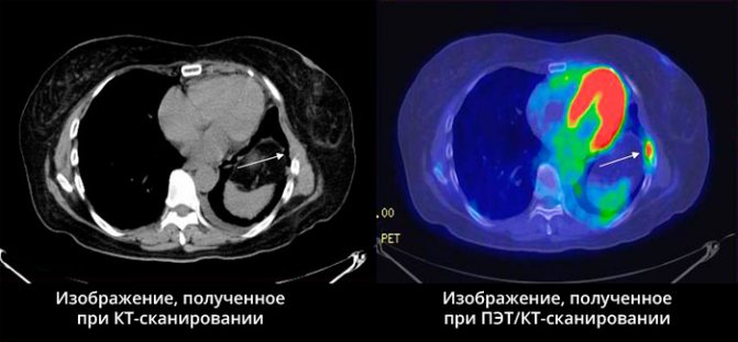 Comparison of CT and PET CT results