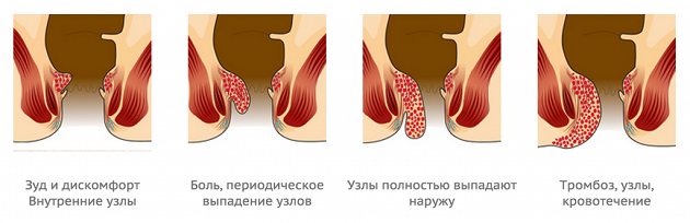 stages of hemorrhoids