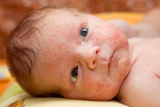 staphylococcus in a child