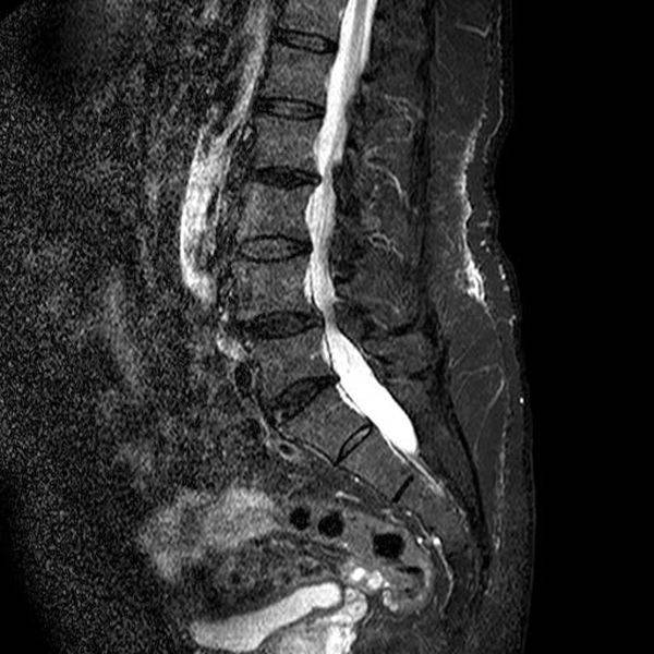 Spinal stenosis on MRI