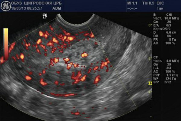 Subinvolution of the uterus on ultrasound