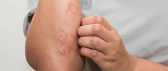 Сверьте ваши симптомы с признаками аллергии