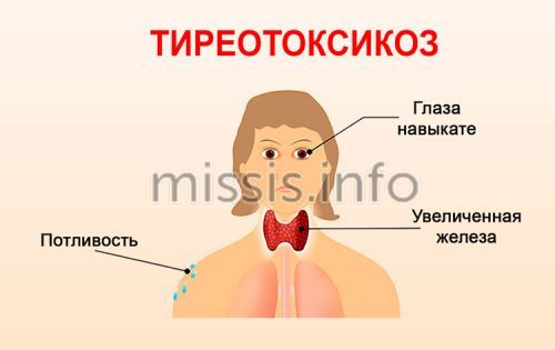 Тиреотоксикоз щитовидной железы