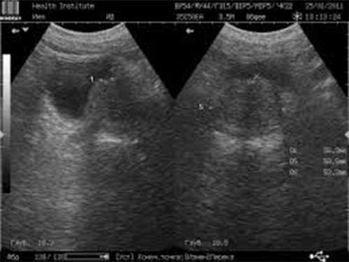 Transabdominal ultrasound of the prostate