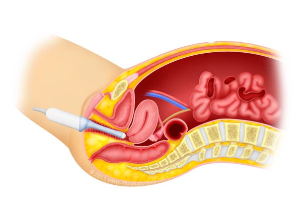 Transvaginal ultrasound of the pelvis