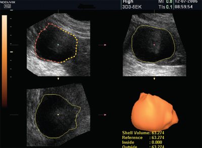 Three-dimensional reconstruction of the surface of a primary splenic cyst