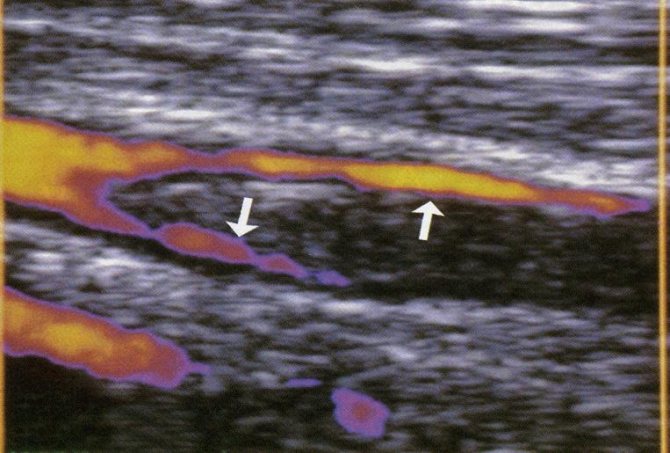 Thrombus in the femoral vein