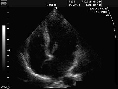 ultrasound ultrasound with an additional chord in the heart