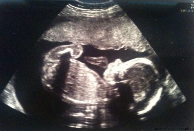 Ultrasound 24 weeks of pregnancy