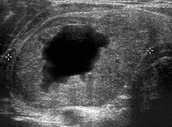 Ultrasound image of thyroid cancer as a dark area on the organ