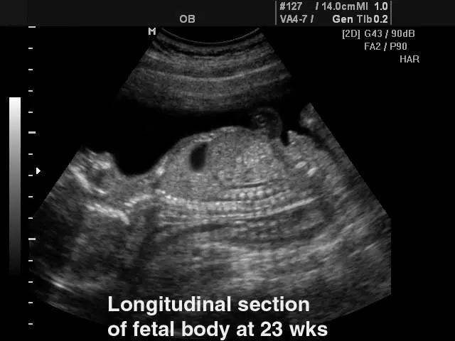 Ultrasound at 23 weeks of pregnancy