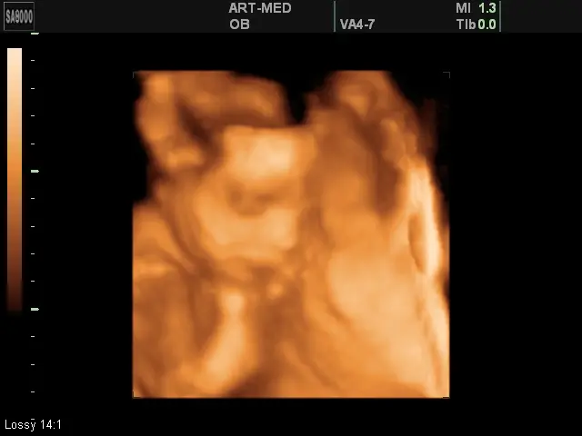 Ultrasound at 24 weeks of pregnancy