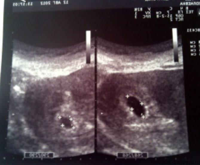 Fetal ultrasound 5 weeks twins