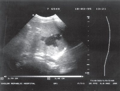 Ultrasound of post-traumatic splenic cyst
