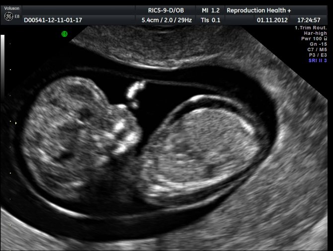 ultrasound during pregnancy