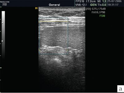 Ultrasound of the spleen in normal mode