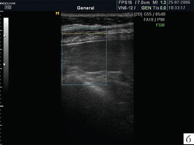 Ultrasound of the spleen in MRI mode