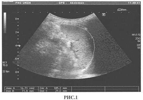 Ultrasound of the spleen